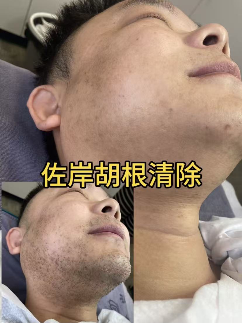台州脱毛
