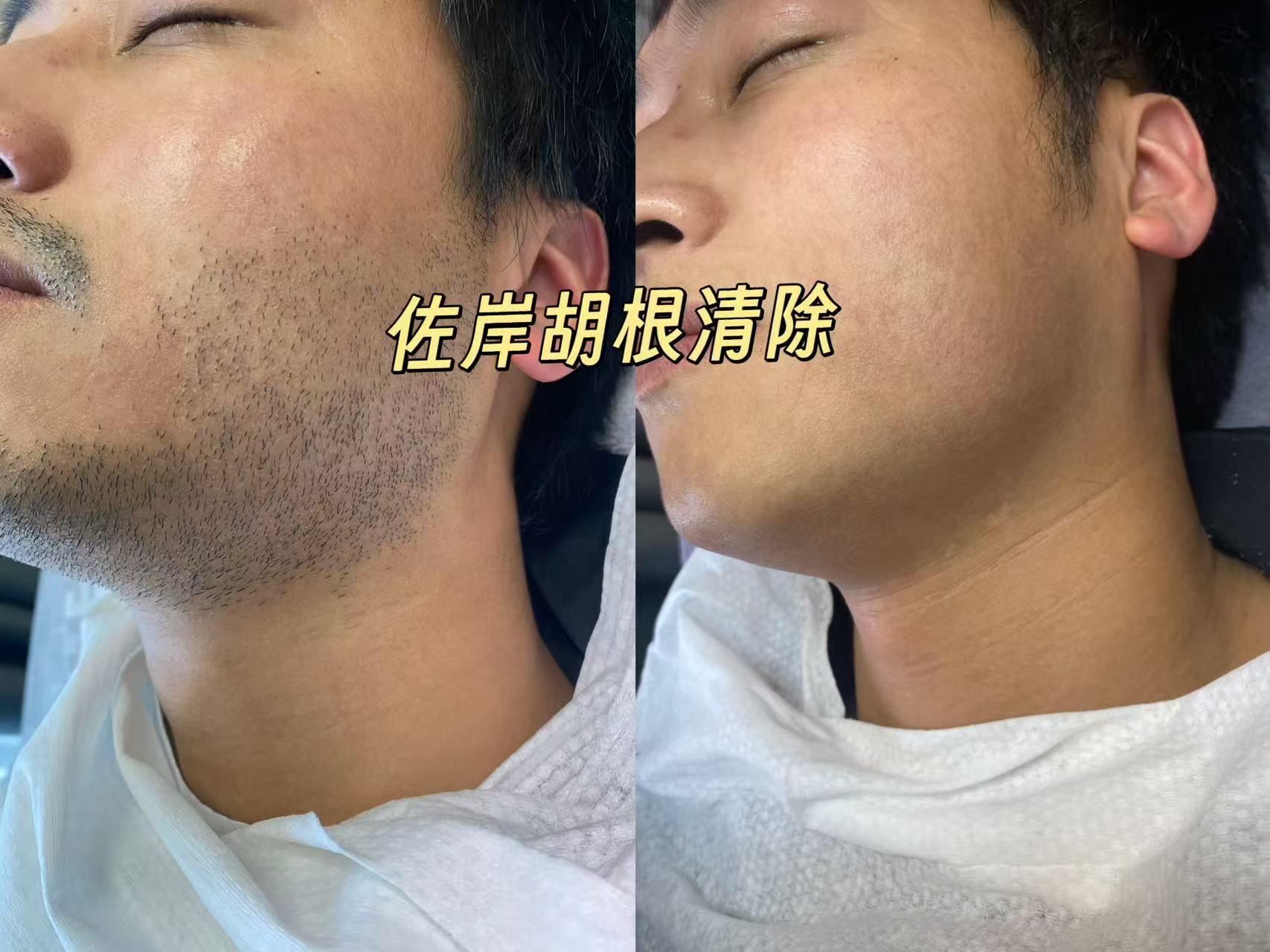 台州脱胡子
